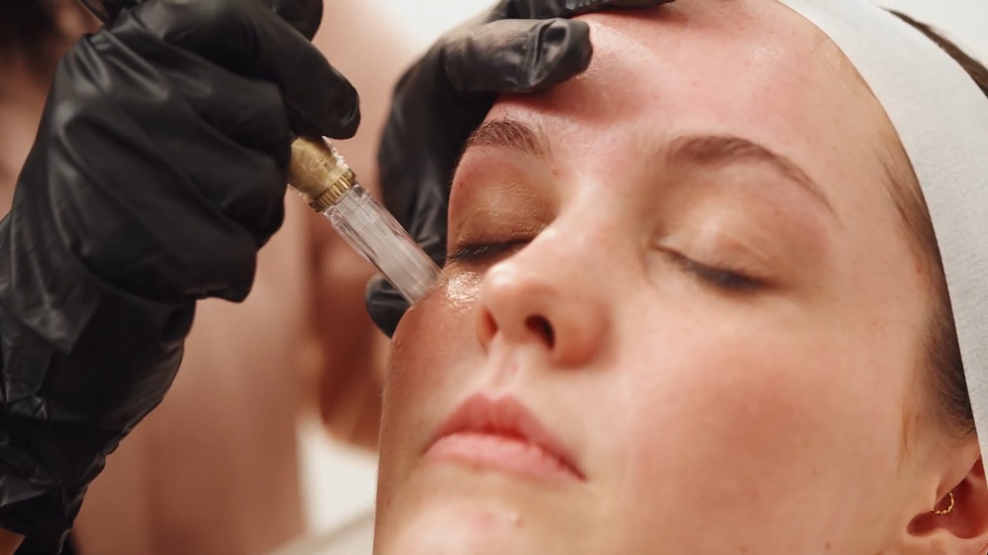 PRP Vampire Facial