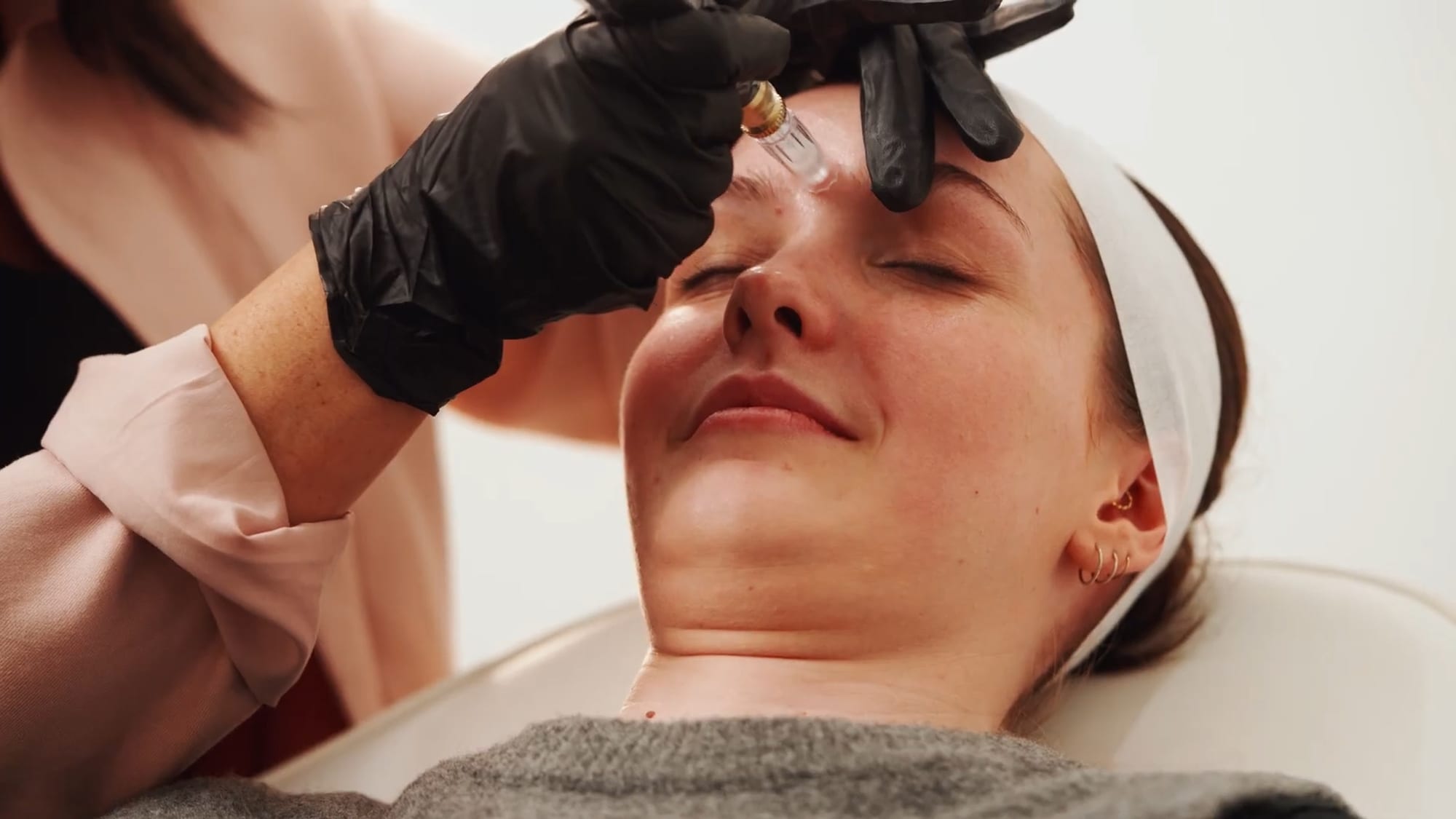 PRP for Hair Loss